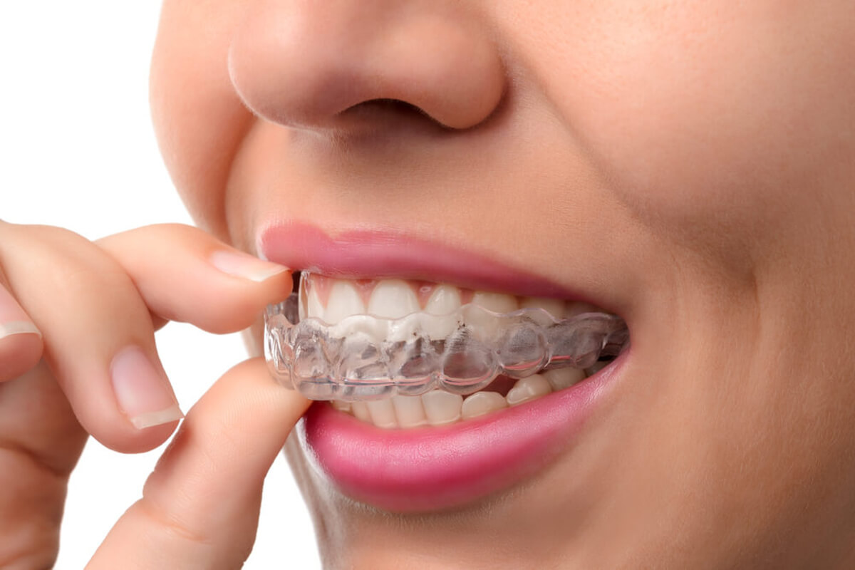 Invisalign Vs Braces, Which Is Better?