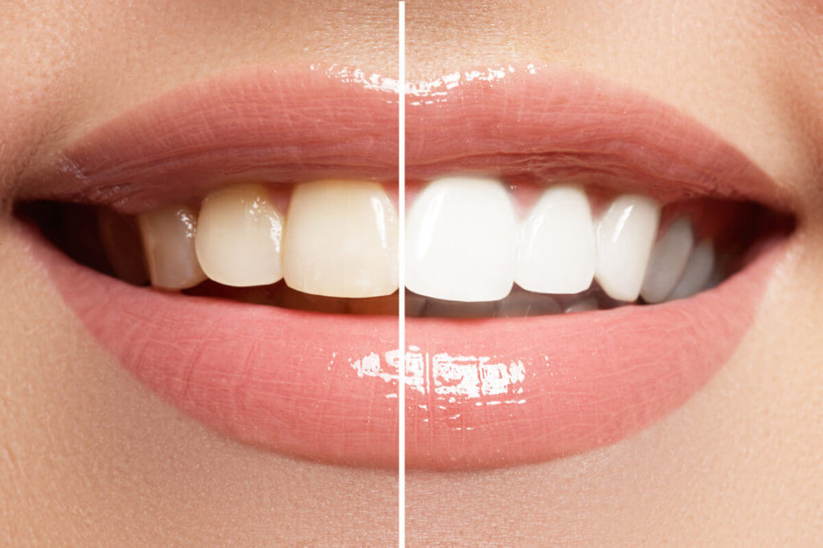 how to whiten teeth and choose glendale dentist