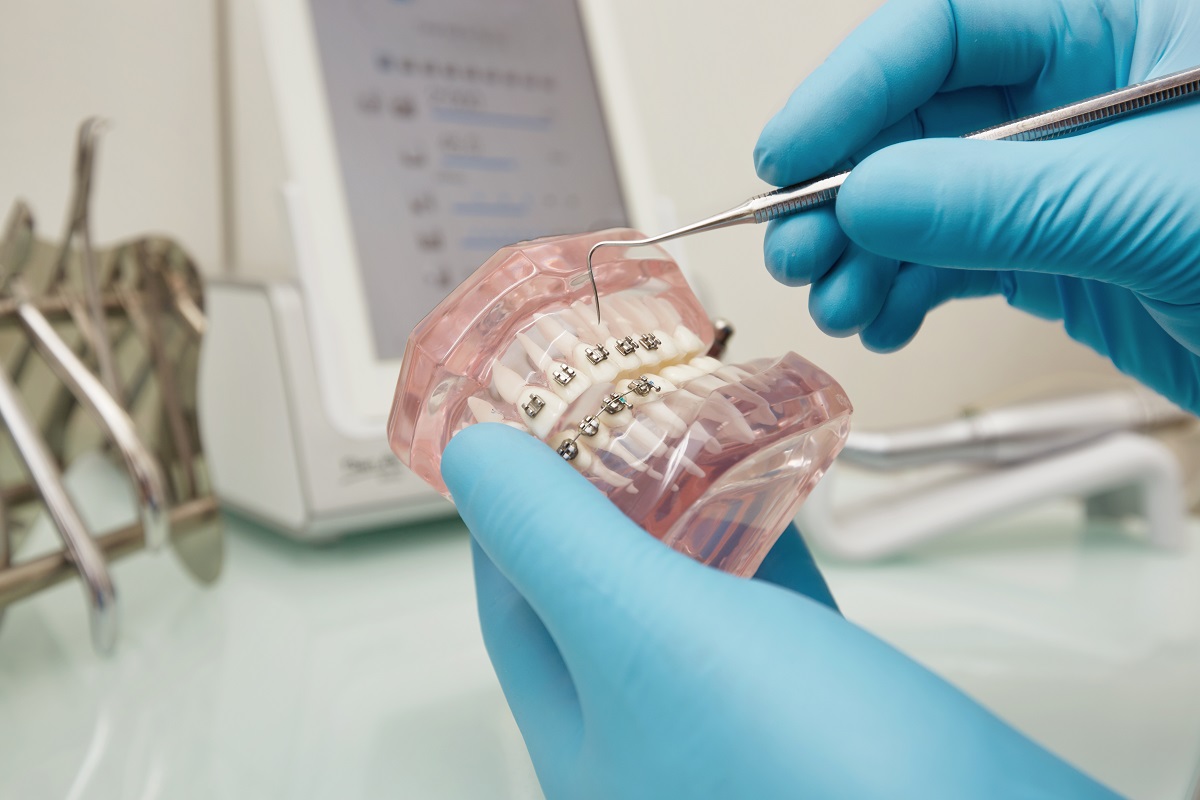 Types of Orthodontic Braces in Phoenix