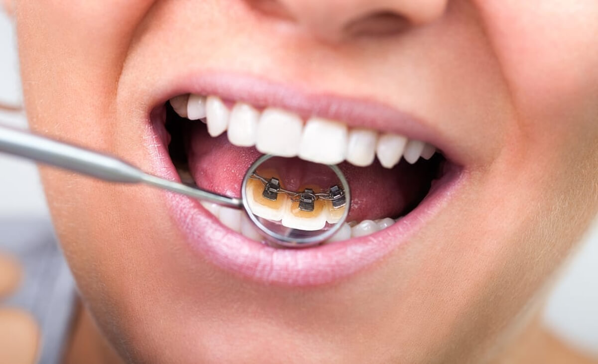 What Are Invisible Braces?