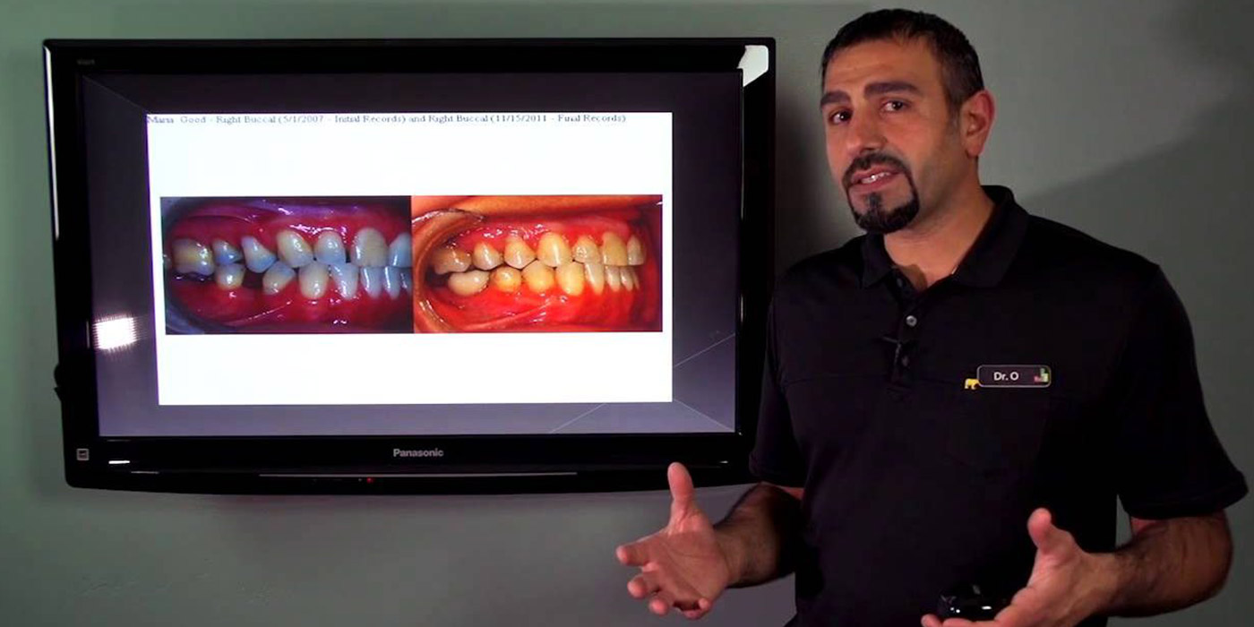 The Basics Of Adult Braces Part #2