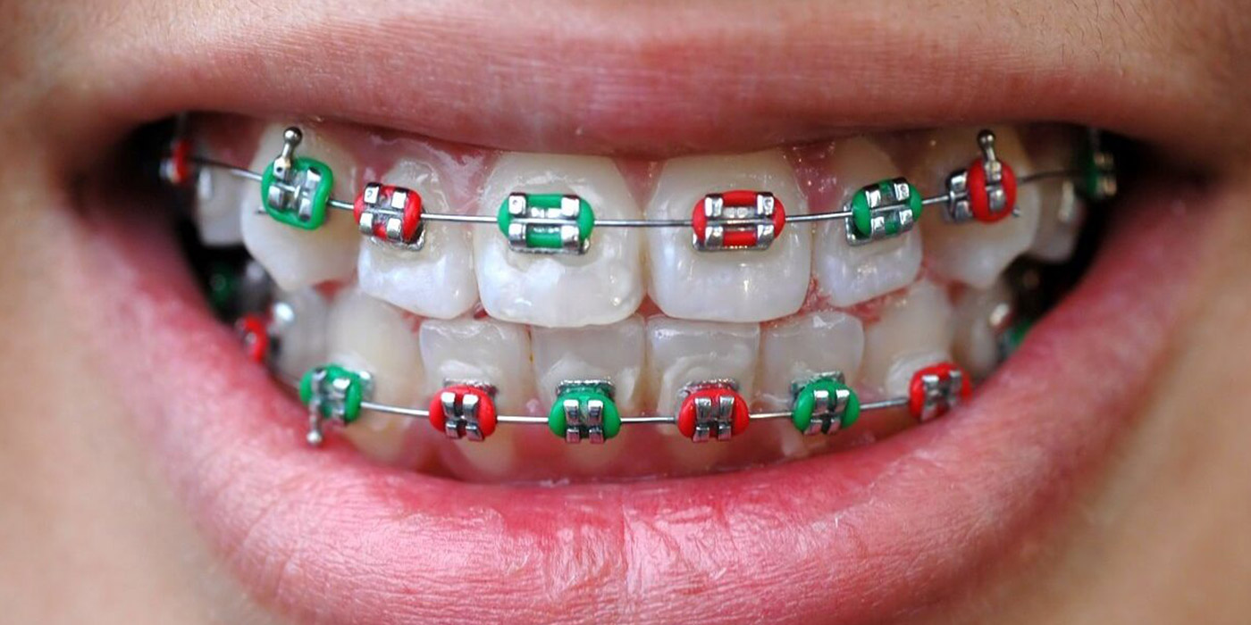 What Color Braces Should You Choose?