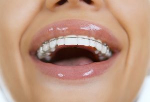 What Is a Bonded Retainer?