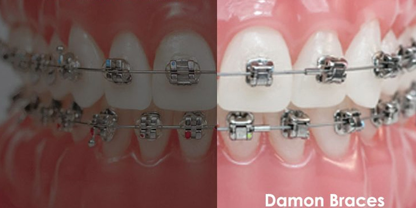 damon braces vs traditional braces