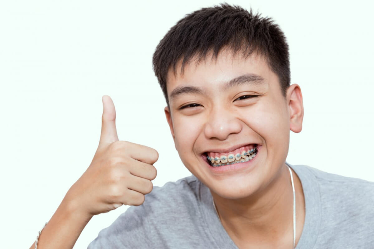 Types of Braces for Adults, Teens and Children