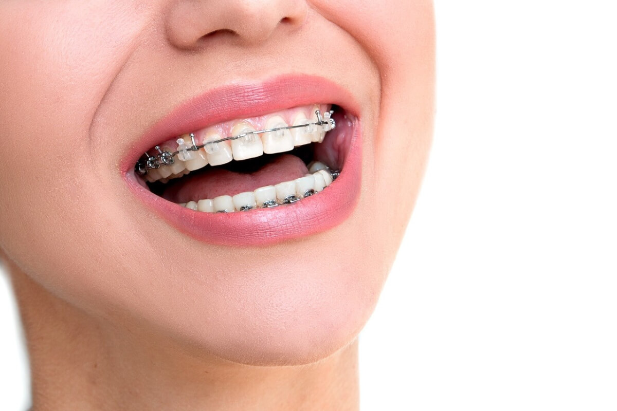 what are the alternatives to braces for adults