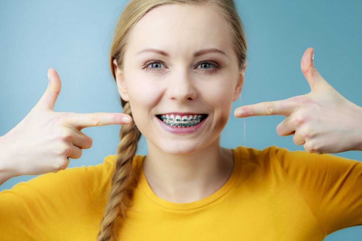 5 Common Misconceptions About Braces