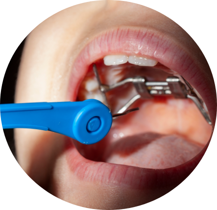 palatal expanders
