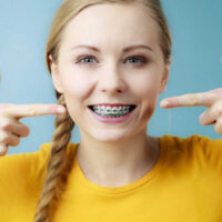 5 Common Misconceptions About Braces