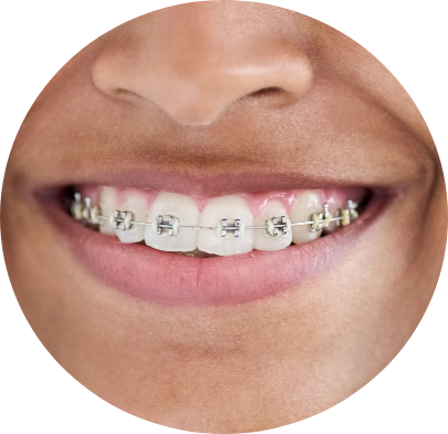 braces metal braces