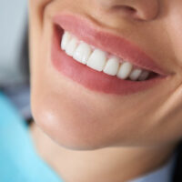 smile-transformation-how-gum-contouring-can-enhance-your-appearance-200x200