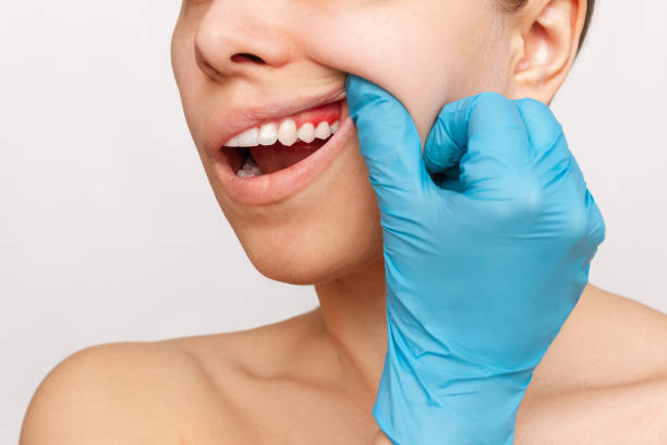 Gum Contouring Guide: Longevity, Eating After Treatment & Essential Care Tips